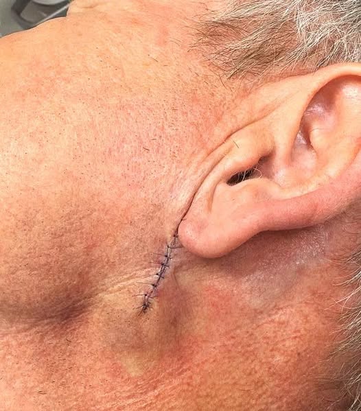 Gordon Ramsay shares shocking photos of his skin cancer surgery! Discover his health scare, recovery, and crucial sunscreen message.
